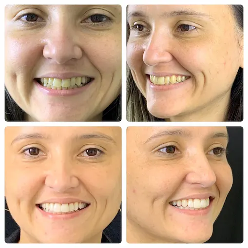 Consultório Dentário Dra Suellem Santos Facetas Clareamento Dental